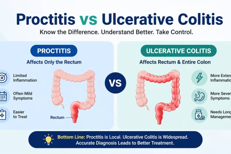 Proctitis vs Ulcerative Colitis comparison infographic showing differences in inflammation, symptoms, and affected areas of the colon