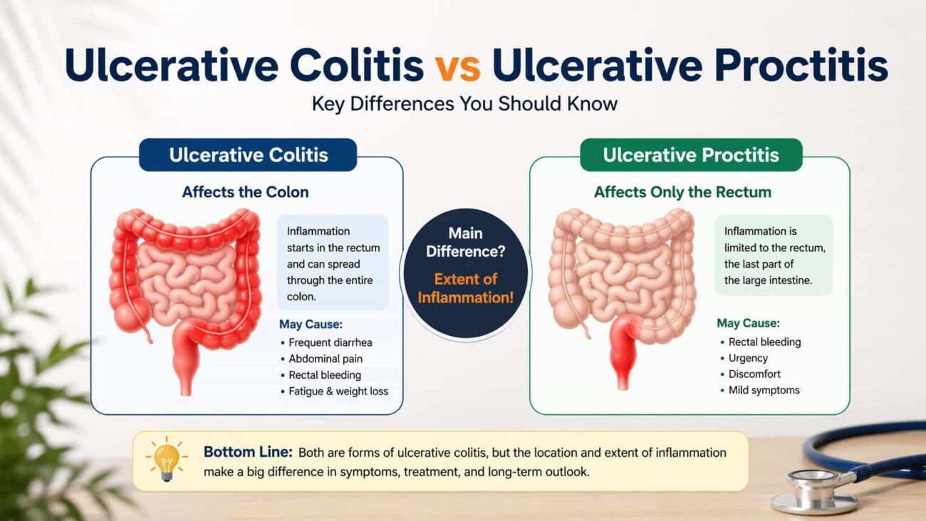 Ulcerative colitis vs ulcerative proctitis comparison infographic showing differences in inflammation, symptoms, and affected areas