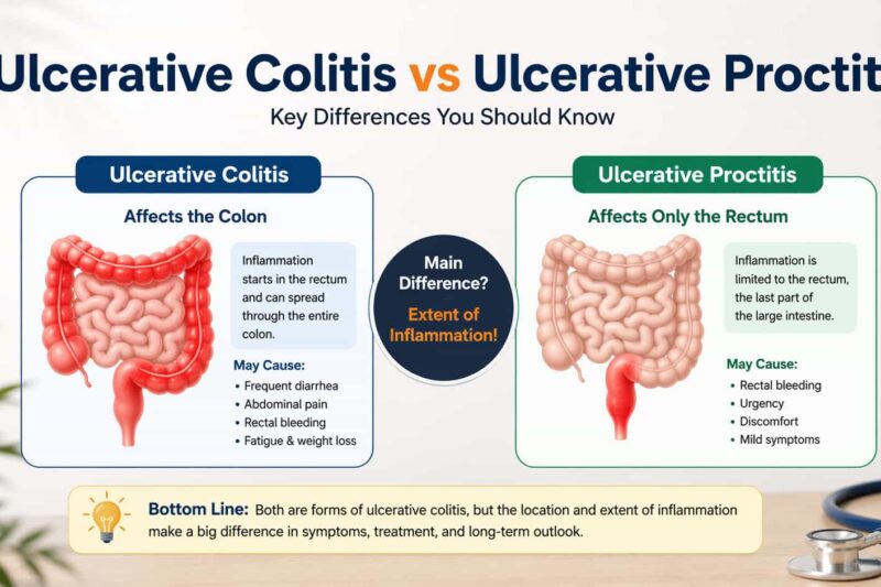 Ulcerative colitis vs ulcerative proctitis comparison infographic showing differences in inflammation, symptoms, and affected areas